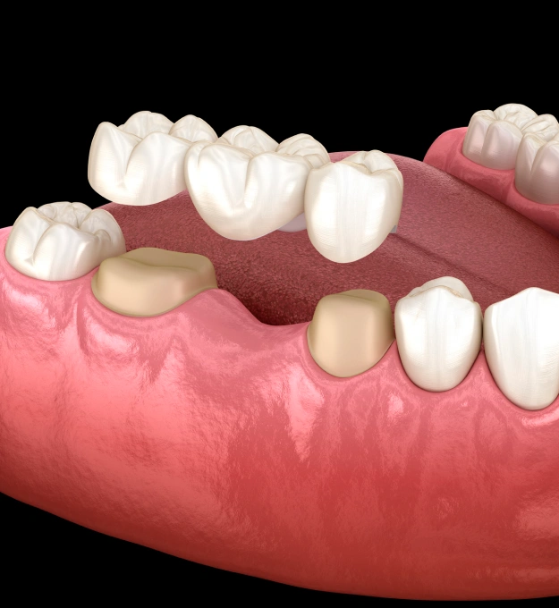 Replace Missing Teeth and Restore Your Smile