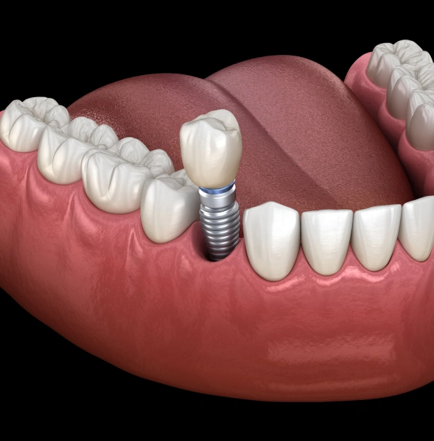 A Long-Lasting Solution for Missing Teeth