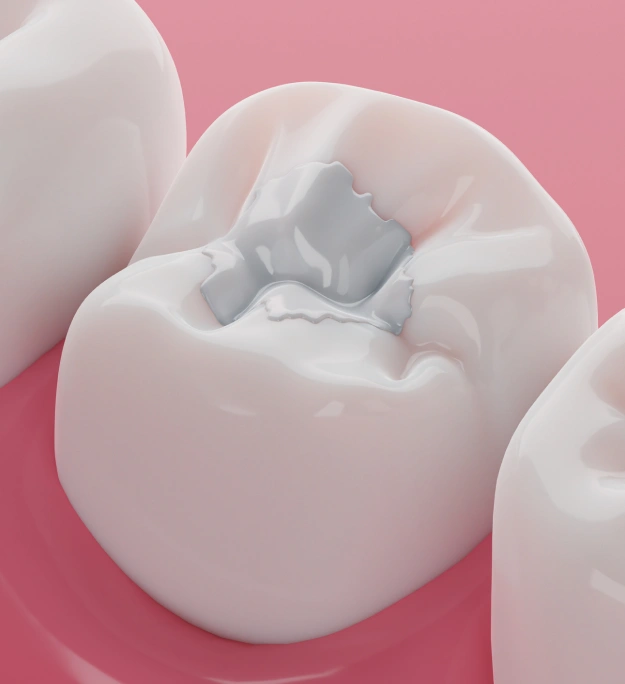 Restore Your Smile With Natural-Looking Dental Fillings