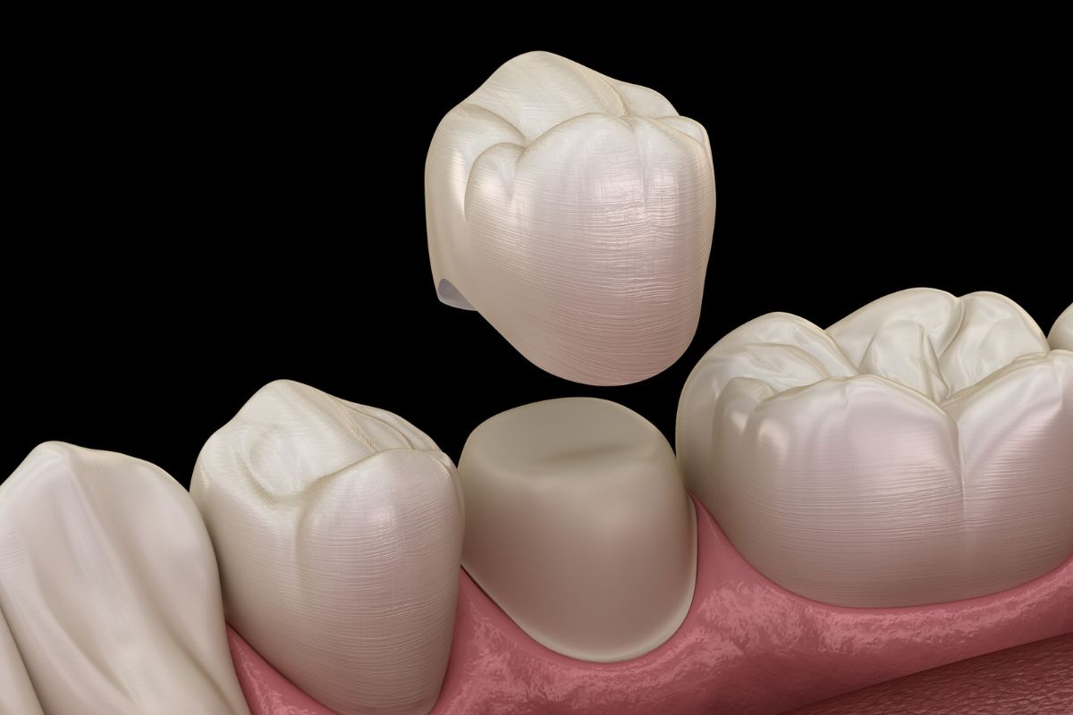 Why Choose a Same-Day Crown?